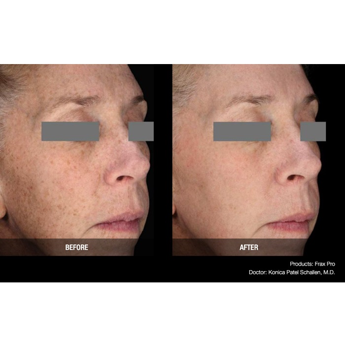 Lasery dermatologiczne Candela FraxPro