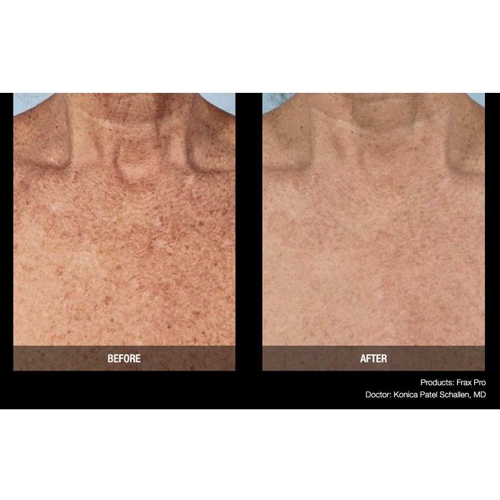 Lasery dermatologiczne Candela FraxPro