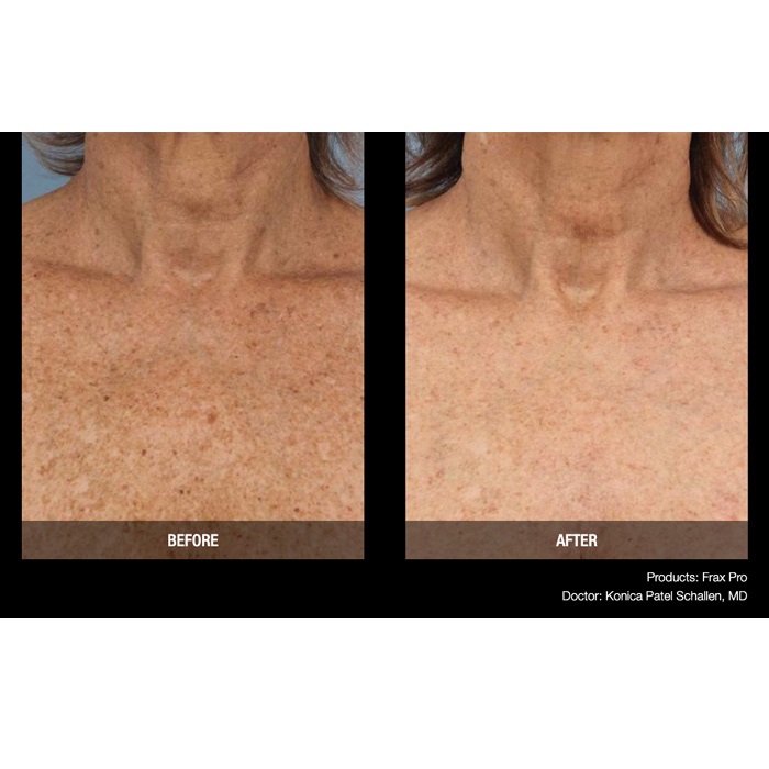 Lasery dermatologiczne Candela FraxPro