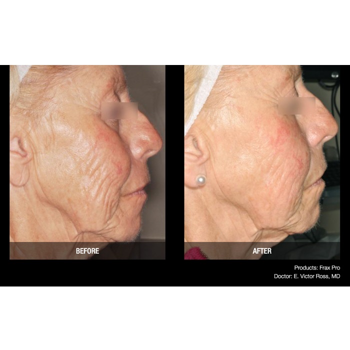 Lasery dermatologiczne Candela FraxPro