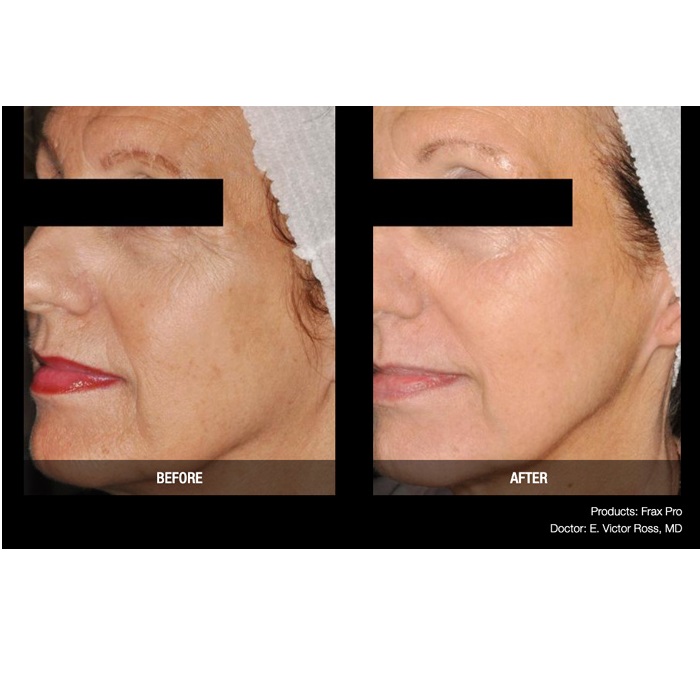 Lasery dermatologiczne Candela FraxPro