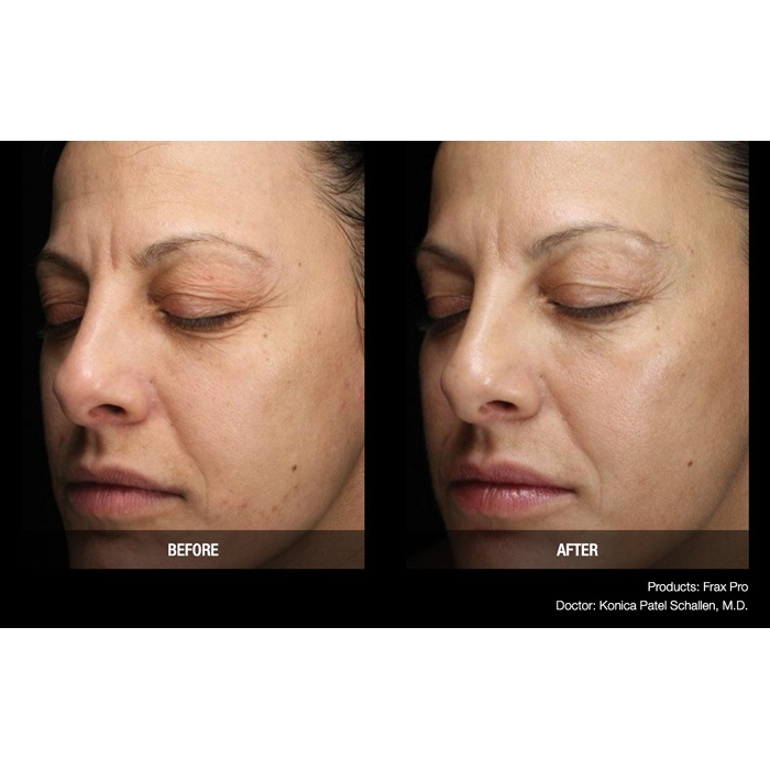 Lasery dermatologiczne Candela FraxPro
