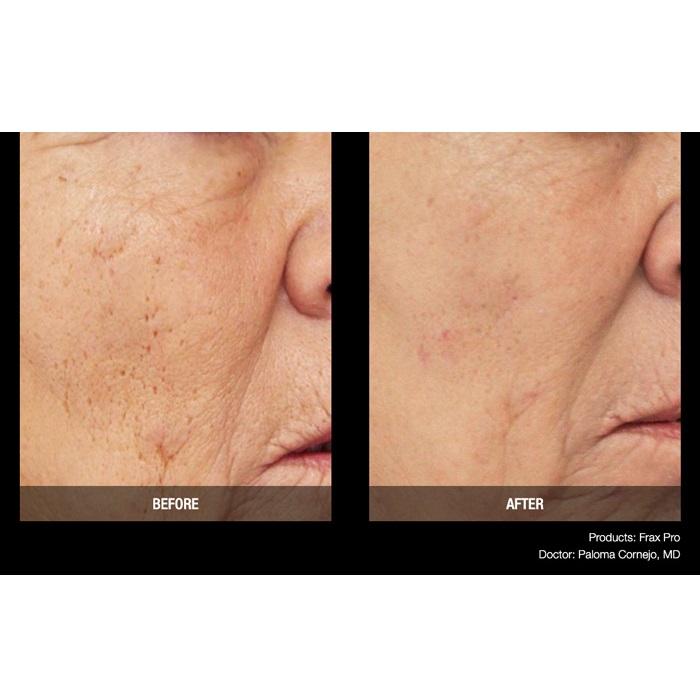 Lasery dermatologiczne Candela FraxPro