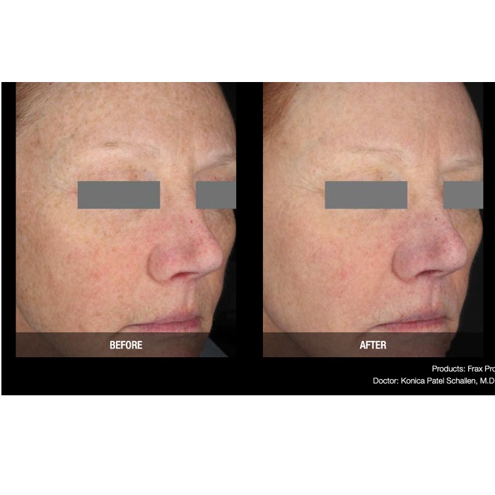 Lasery dermatologiczne Candela FraxPro