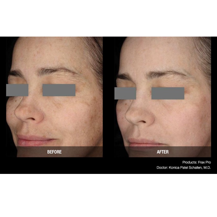 Lasery dermatologiczne Candela FraxPro