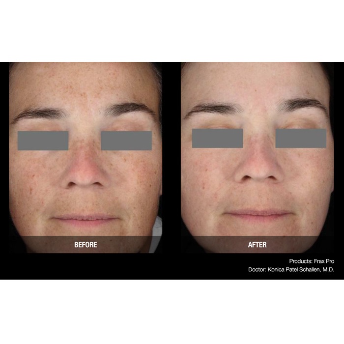 Lasery dermatologiczne Candela FraxPro