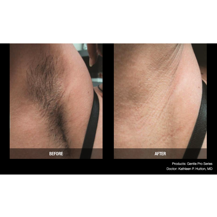 Lasery dermatologiczne Candela GentlePro