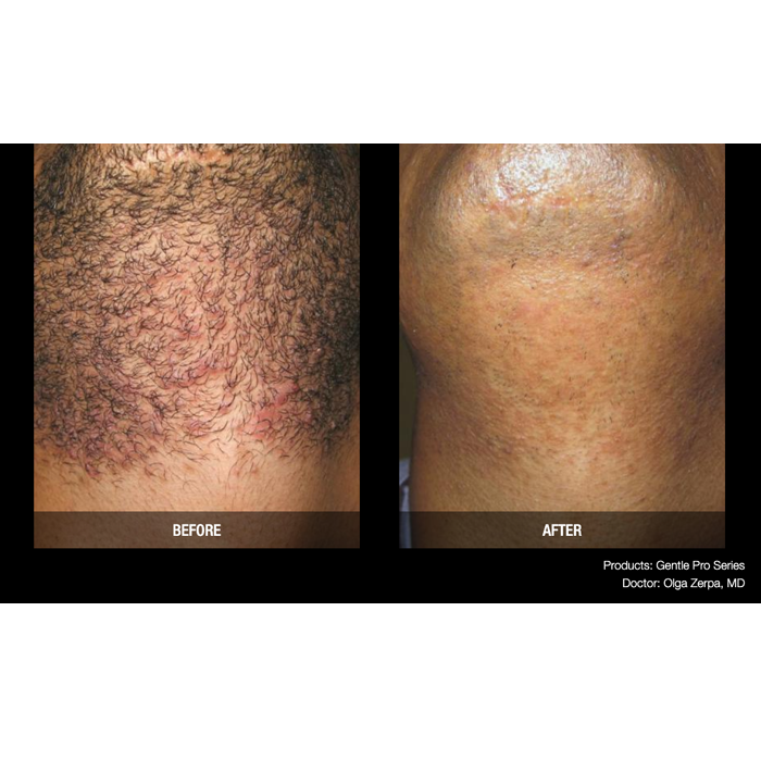 Lasery dermatologiczne Candela GentlePro