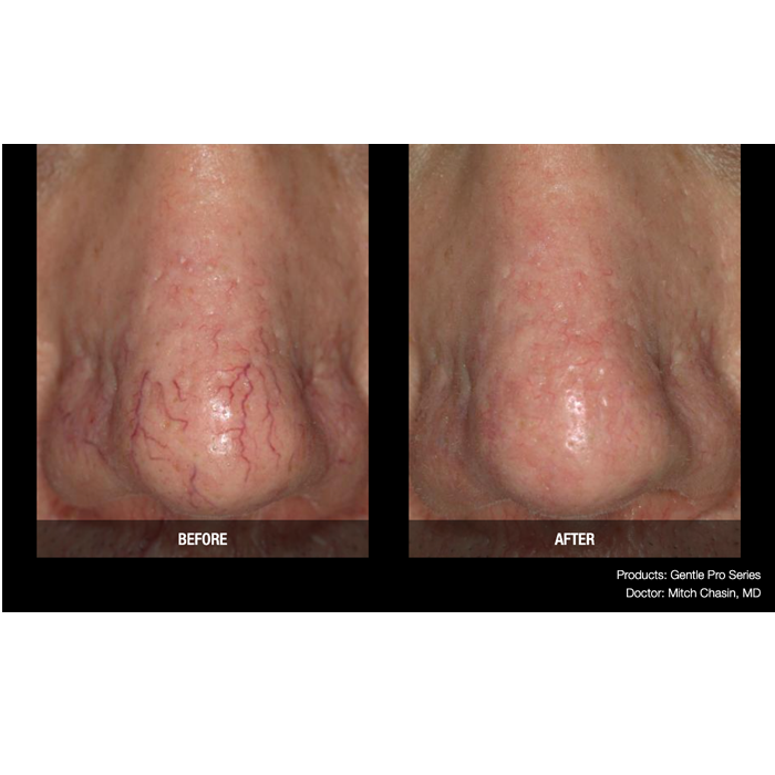 Lasery dermatologiczne Candela GentlePro