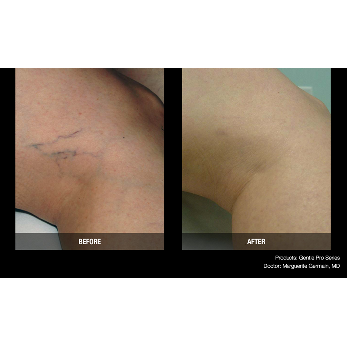 Lasery dermatologiczne Candela GentlePro