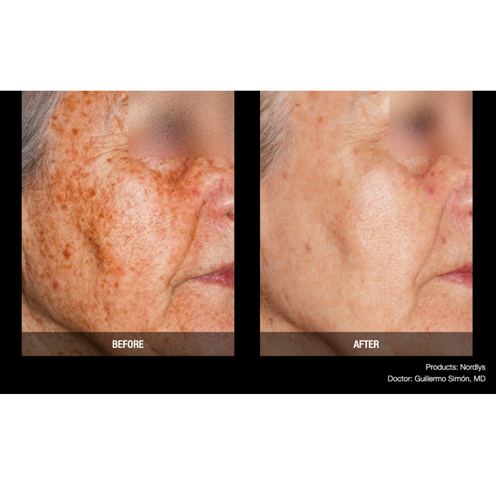 Lasery dermatologiczne Candela Nordlys