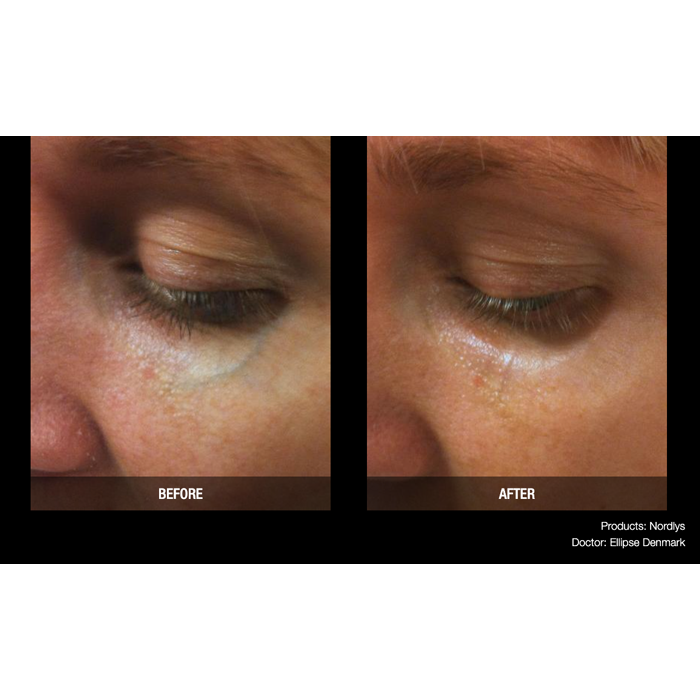 Lasery dermatologiczne Candela Nordlys