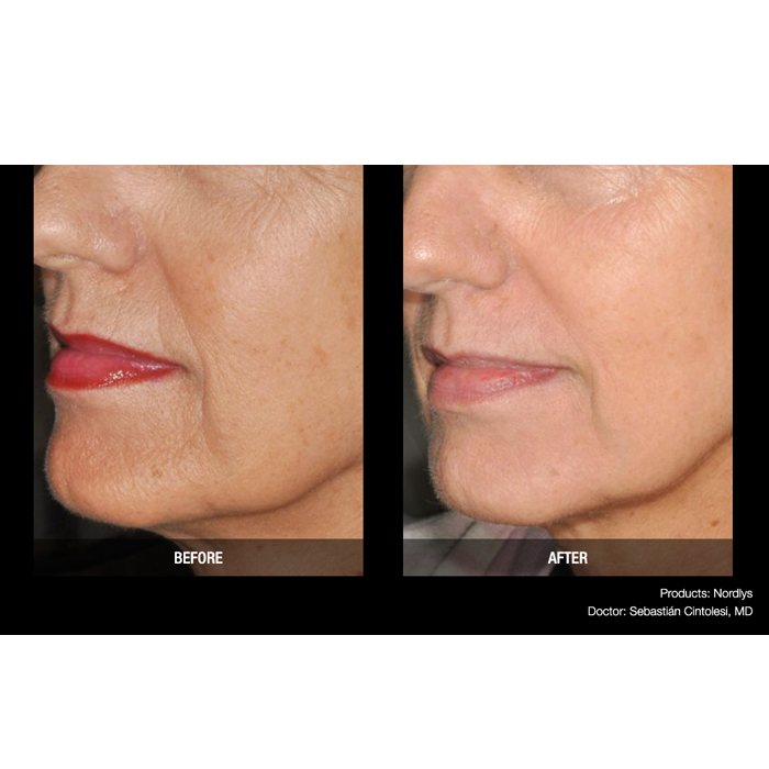 Lasery dermatologiczne Candela Nordlys