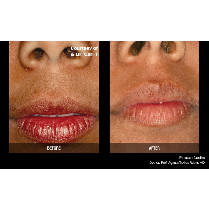 Lasery dermatologiczne Candela Nordlys