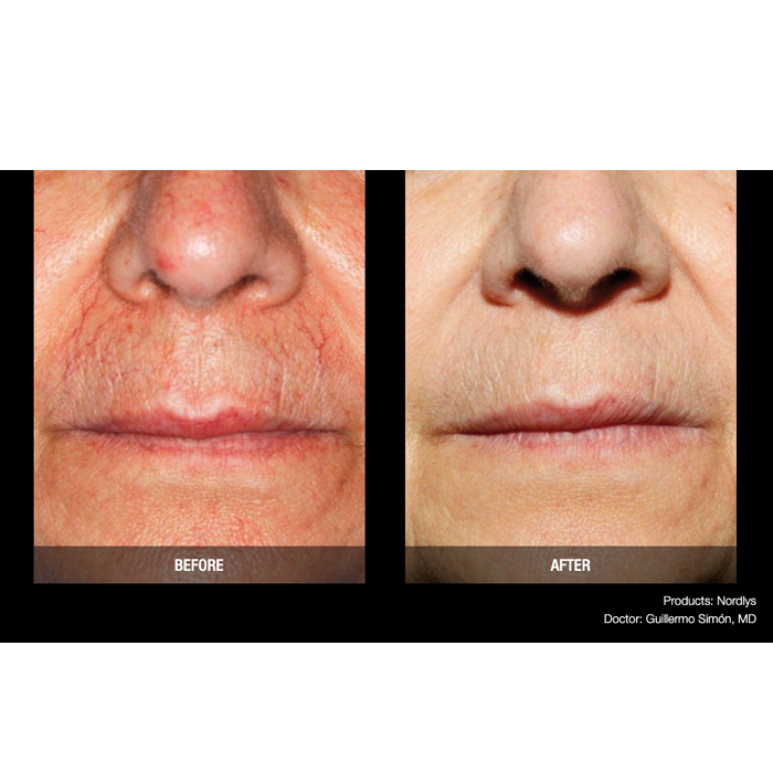 Lasery dermatologiczne Candela Nordlys