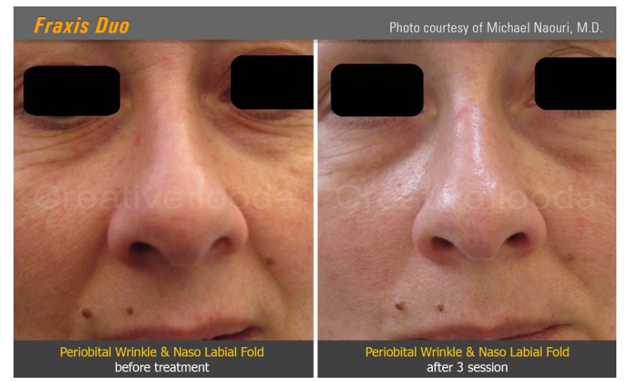 Lasery dermatologiczne Classys Fraxis DUO