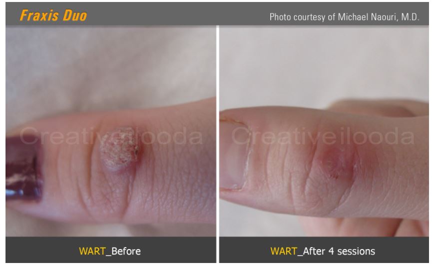 Lasery dermatologiczne Classys Fraxis DUO