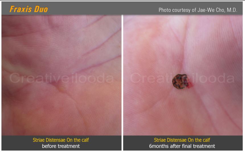 Lasery dermatologiczne Classys Fraxis DUO