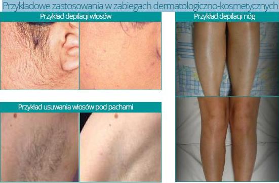 Lasery dermatologiczne CTL 1551 - Doris Plus HR 810 nm