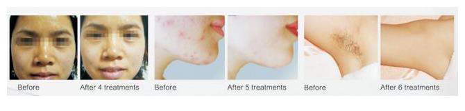 Lasery dermatologiczne GSD DUAL LASER SPTF+