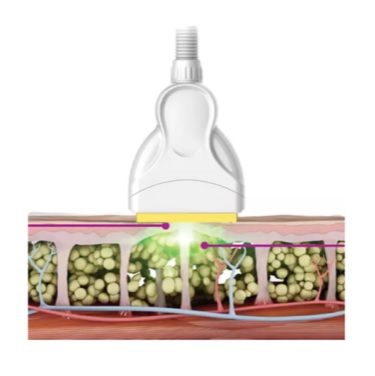 Lasery dermatologiczne HiLite Laser Shape