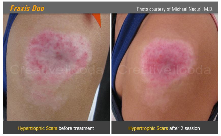 Lasery dermatologiczne ilooda Fraxis DUO