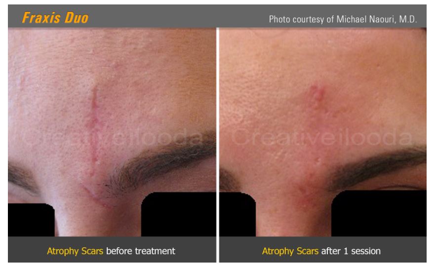 Lasery dermatologiczne ilooda Fraxis DUO