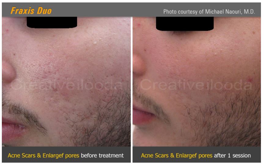 Lasery dermatologiczne ilooda Fraxis DUO