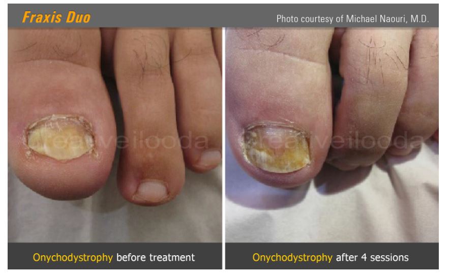 Lasery dermatologiczne ilooda Fraxis DUO