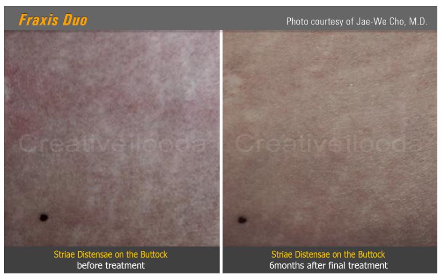 Lasery dermatologiczne ilooda Fraxis DUO