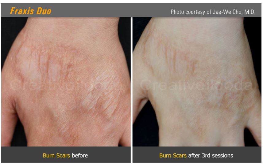 Lasery dermatologiczne ilooda Fraxis DUO