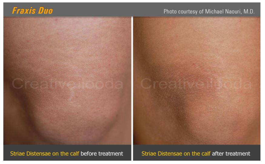 Lasery dermatologiczne ilooda Fraxis DUO