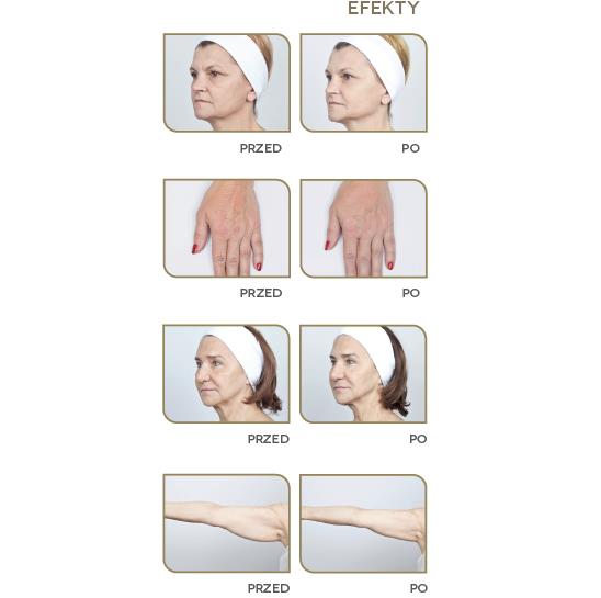 Lasery dermatologiczne Neauvia Devices Zaffiro