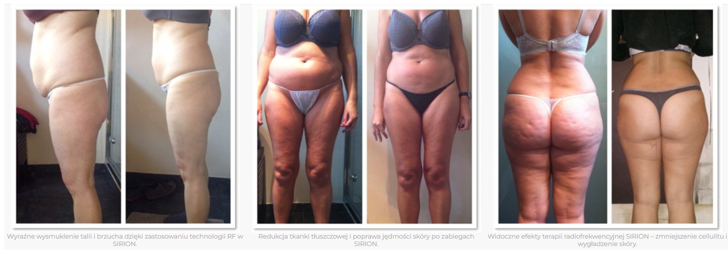 Lasery dermatologiczne Sayton Medical SIRION