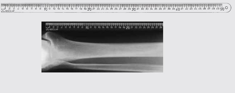 Linijki RTG B.Braun Linijki RTG B.Braun