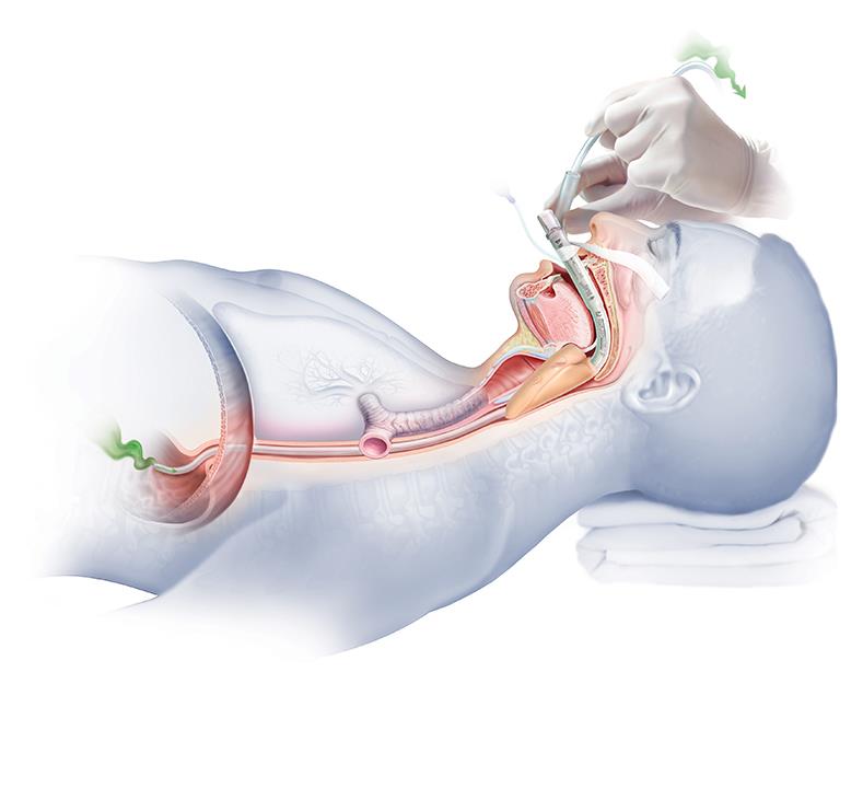 Maski krtaniowe LMA ProSeal