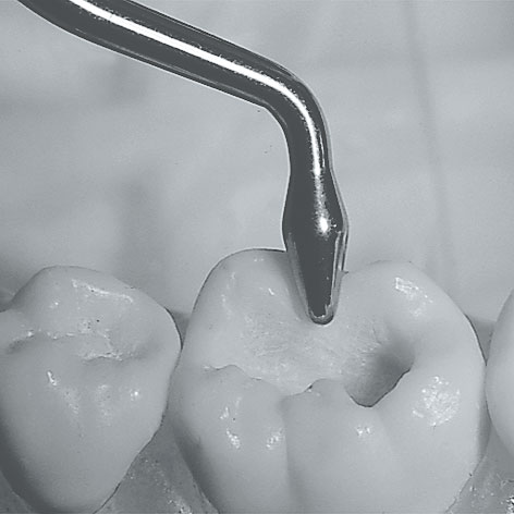 Modelarzyki stomatologiczne LM-Instruments Modelarzyk IO