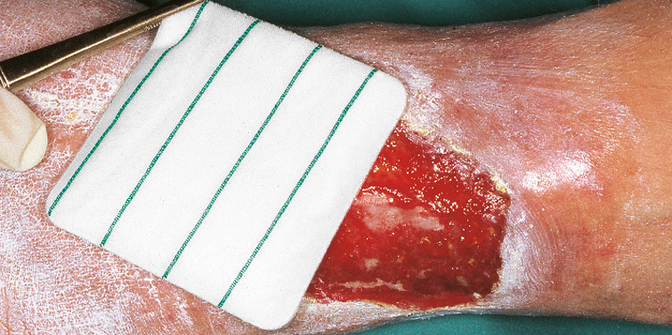 Opatrunki polimerowe i hydropolimerowe HARTMANN TenderWet