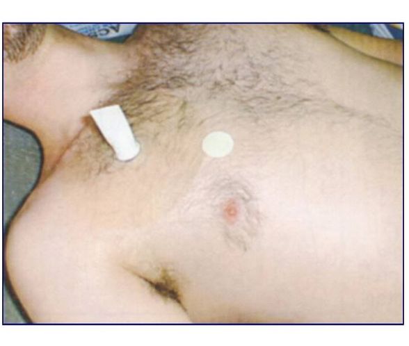 Opatrunki wentylowe Rusch ASHERMANN CHEST SEAL