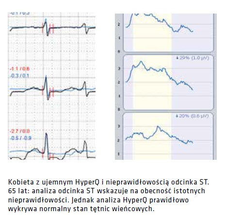 Oprogramowanie do Aparatów EKG HyperQ Wysiłkowe
