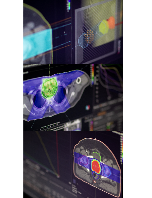 Oprogramowanie do radioterapii B/D RayStation