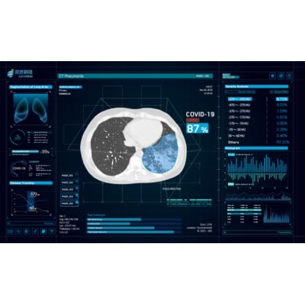 Oprogramowanie do wykrywania COVID-19 podczas badania TK InferVision InferRead CT Lung COVID-19