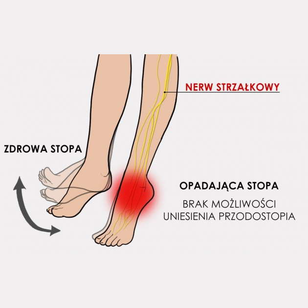 Ortezy na opadającą stopę REH4MAT OSS-OS-02