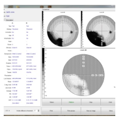 Perymetry komputerowe - polomierze FREY AP-300