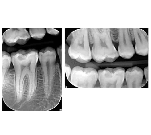RTG punktowe wewnątrzustne Dexis Focus