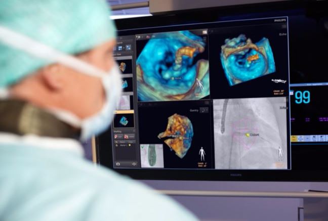 RTG śródoperacyjne (Ramię C) PHILIPS EchoNavigator