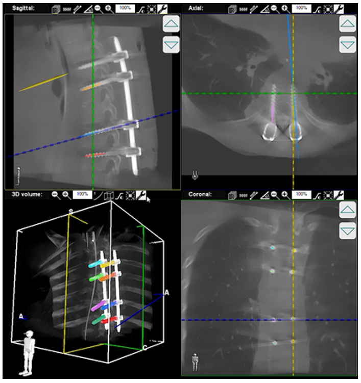 RTG śródoperacyjne (Ramię C) ZIEHM Imaging Vision RFD 3D