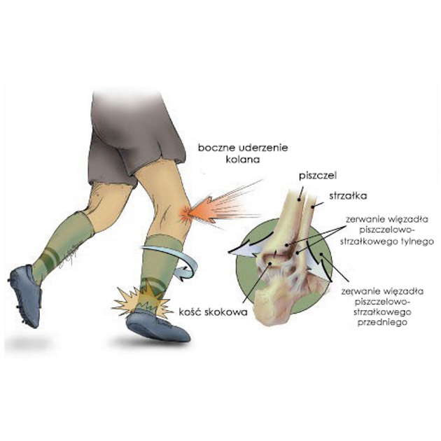 Stabilizatory stawu skokowego REH4MAT AM-OSS-06