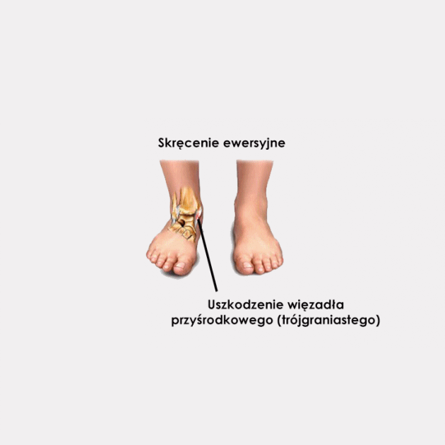 Stabilizatory stawu skokowego REH4MAT AM-OSS-06