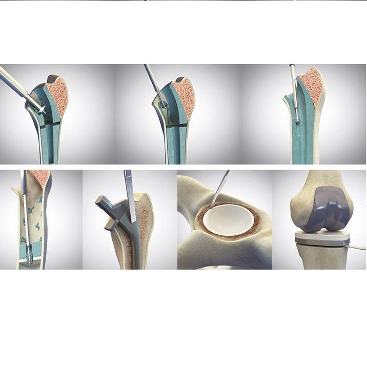 Systemy do zabiegów rewizyjnych Orthosonics OSKAR III